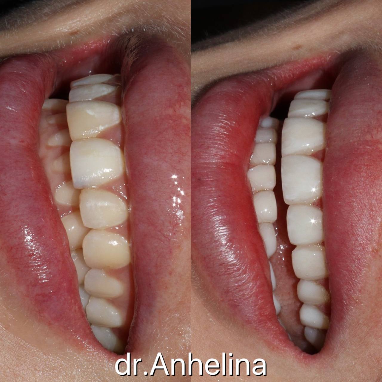 Галерея Angelina Dental 1